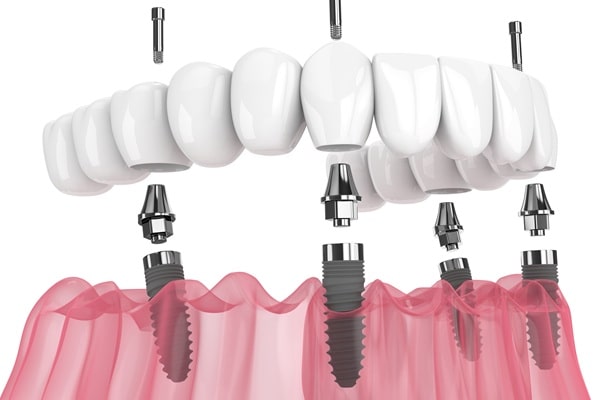 all-on-4-dental-implants-empire-dental