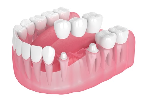 dental-bridges-empire-dental