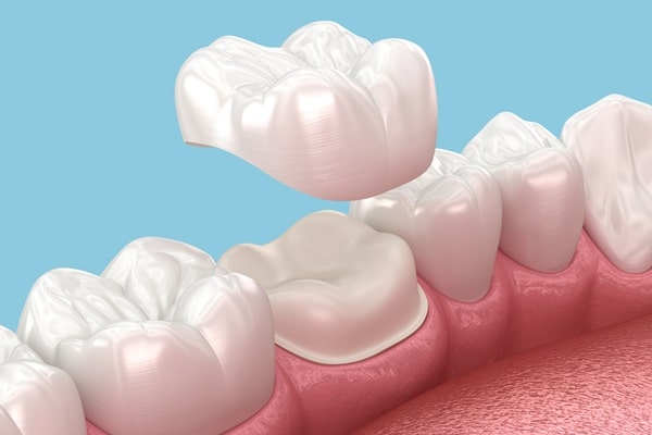dental-crowns-empire-dental