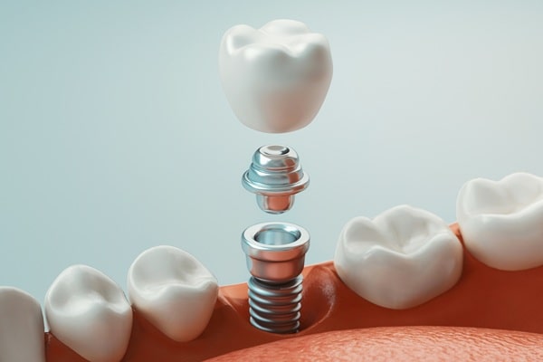 dental-implants-empire-dental
