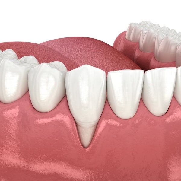 whats-included-in-a-gum-grafting-procedure