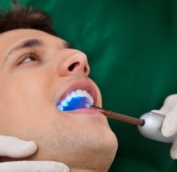 whats-included-in-a-sealant-appointment