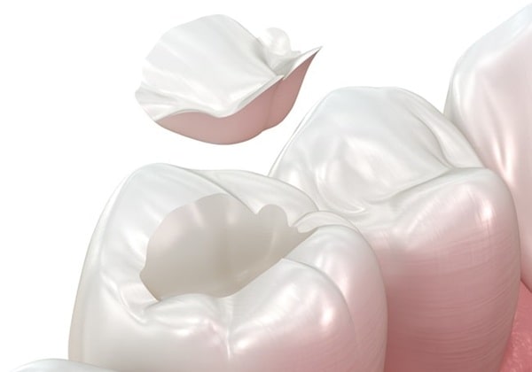 whats-included-in-inlay-and-onlay-treatment