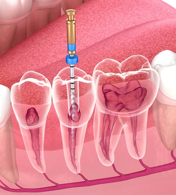 whats-included-in-root-canal-treatment