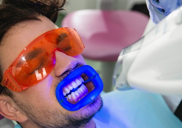 whats-included-in-whitening-treatment