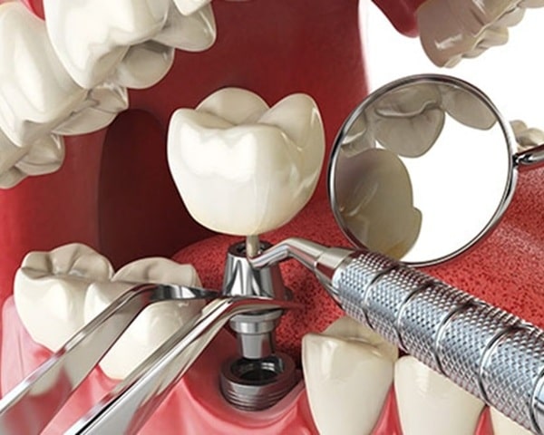 whats-involved-in-implant-treatment